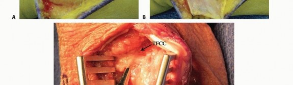 Illustration 14 for Galeazzi DRUJ Stabilization: Unlocking Stability with Smooth Stainless Steel