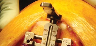 Illustration 18 for Cemented TKA Figure: Your Visual Guide to Surgical Success