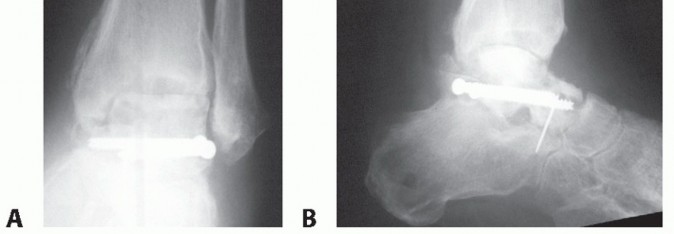 Illustration 7 for Beyond Amputation: Circular Fixation for Infection of the Talus