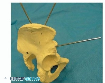Illustration 8 for Emergency Fixation of the Pelvis: Control Bleeding & Restore Stability