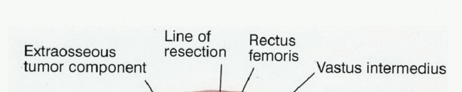 Advanced Distal Femoral Resections: Limb-Sparing Outcomes & Techniques