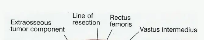 استئصال عظم الفخذ البعيد المتقدم: جراحة الحفاظ على الأطراف ونتائجها في صنعاء مع الأستاذ الدكتور محمد هطيف