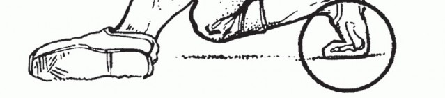 Illustration 8 for Restore Your Foot: Surgical Treatment for Hallux MP Joint Turf Toe