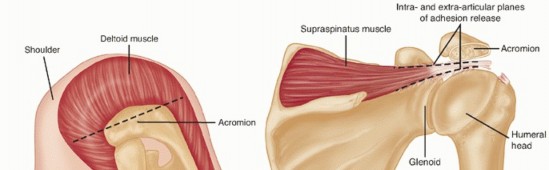 Illustration 10 for Restore Shoulder Function with Latissimus Dorsi Tendon Transfer