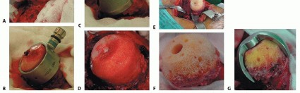 Illustration 10 for Hip Resurfacing: The Bone-Sparing Solution around the Femoral Head