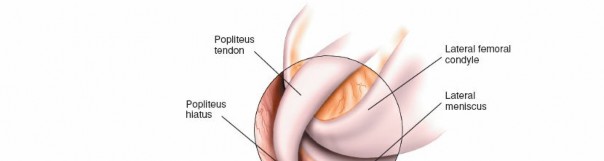 Illustration 7 for Mastering Knee Arthroscopy Approaches: Safely Withdraw the Arthroscope