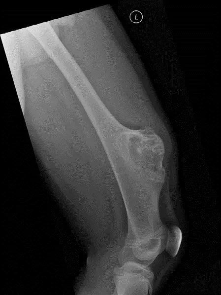 صورة توضيحية لـ إتقان التعامل مع الورم العظمي الغضروفي: دليل شامل للمرضى بخبرة الأستاذ الدكتور محمد هطيف في صنعاء