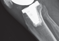 صورة طبية: استبدال مفصل الركبة بالحد الأدنى من التدخل الجراحي: ألم أقل وتعافٍ أسرع مع النهج شبه الرضفي الإنسي