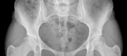 Bernese Periacetabular Osteotomy: Your Definitive Case Title Bernese