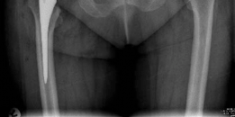 Illustration 4 for Achieving Success with Uncemented Hip Arthroplasty Metal Socket