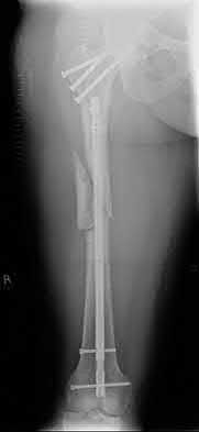 Illustration 113 for OrthoCash: Trauma MCQs & Cases for a yearold woman