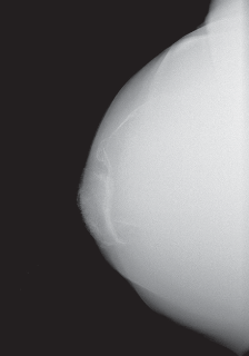 Mastering Valgus Total Knee Replacement: Techniques & Pitfalls