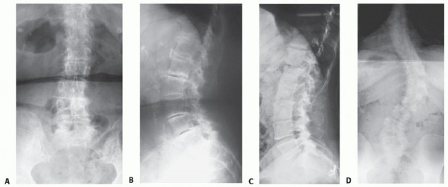 Adult Scoliosis: Uncover Causes & Find Lasting Back Pain Relief