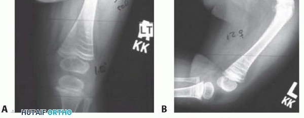 Illustration 10 for Less Pain, More Function: Fassier-Duval Nailing for Osteogenesis Imperfecta