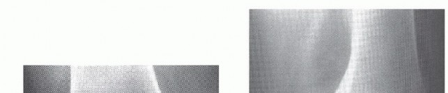 Illustration 22 for Dissecans of the Knee: What's the Difference – OCD vs. AVN?