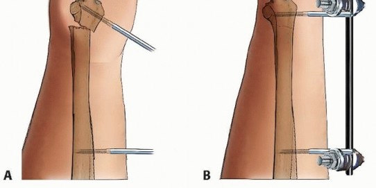 Illustration 27 for Effective K-Wire Fixation: Distal Radius Fractures Without External Fixation