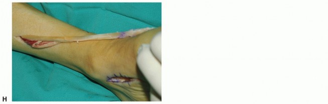 Illustration 10 for Restore Movement: Tendon Transfer for Common Peroneal Nerve Foot Drop