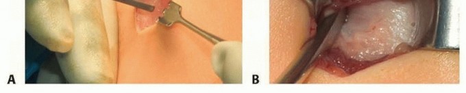 Illustration 13 for Less Pain, More Function: Fassier-Duval Nailing for Osteogenesis Imperfecta