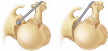 Find Relief from Shoulder DJD: Arthroscopic Débridement and Glenoidplasty
