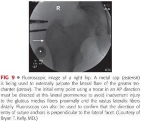 Illustration 101 for Periarticular Arthroscopy: Addressing Medius & Minimus Tears