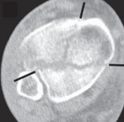 Illustration 10 for Optimizing ORIF for Tibial Plafond Fractures: A Modern Approach