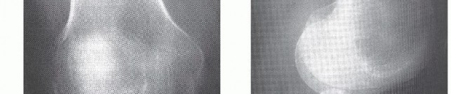 Illustration 23 for Dissecans of the Knee: What's the Difference – OCD vs. AVN?