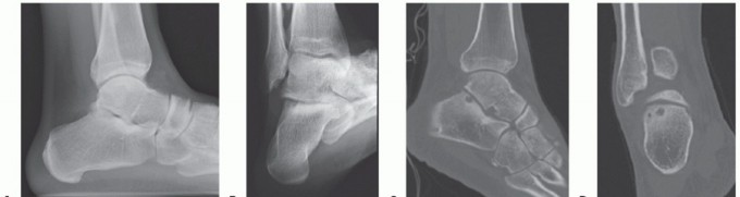 Subtalar Arthroscopy: Solving the Mystery of Sinus Tarsi Syndrome