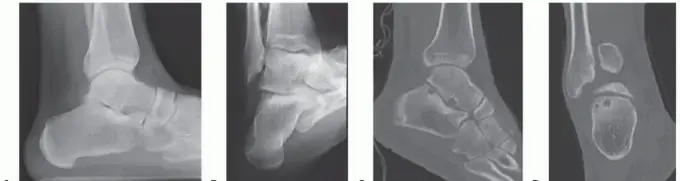 صورة توضيحية لـ تنظير المفصل تحت الكاحل: حل متقدم لآلام الكاحل المزمنة واستعادة حركتك مع الأستاذ الدكتور محمد هطيف