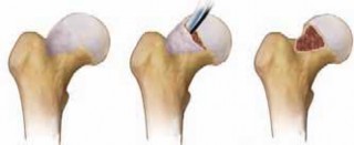 Illustration 30 for FAI: Impingement and Surgical Dislocation Explained