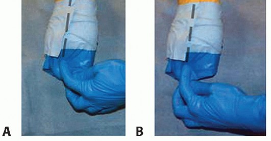 Illustration 8 for Posterior Talar Process: Endoscopic Solutions for Ankle Pain