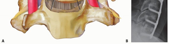 Illustration 11 for How ACDF Clears Your Posterior Disc Space for Lasting Relief