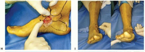 Illustration 61 for Medial Ankle Instability: Find Relief with Reconstruction
