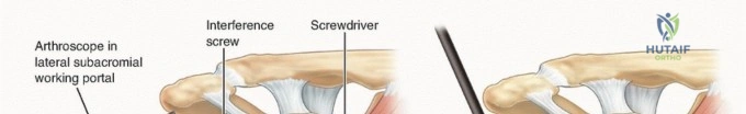 ABOS Part I Orthopaedic Review: TKA Revision & Hallux Valgus Surgical Management | Part 21607