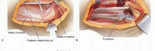 Illustration 3 for Well-Fixed THA Revisions: Precision in the Portion of the Osteotomy