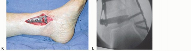 Illustration 8 for Unlock Ankle Preservation: Supramalleolar Closing Wedge Osteotomy