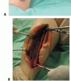 Illustration 26 for Free Vascularized Fibular Grafts: Solving Complex Bone Defects