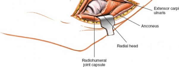 Illustration 98 for Mastering Elbow Approaches: Applied Surgical Anatomy for Precision