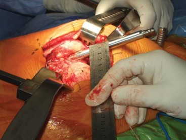 Illustration 75 for Successful Total Hip Replacement in Developmental Dysplasia