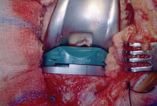 Illustration 58 for Mastering TKA: Essential Methods of Rotational Alignment