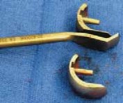 Illustration 23 for Knee Arthroplasty Unicondylar: Discover if Partial Knee Replacement is Right