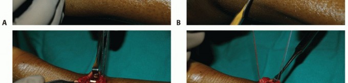Mini-Open Achilles Repair: Optimal Healing within the Paratenon