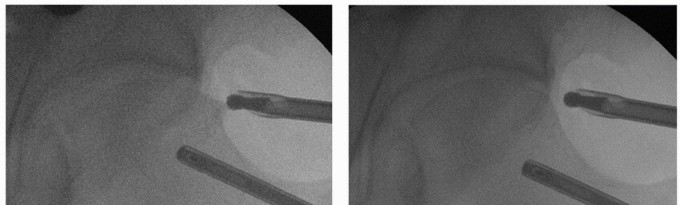Illustration 32 for Beyond Knee Surg: Hip Arthroscopy for Sports Injuries
