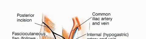 Illustration 34 for Surgical Pelvic Resection: Gluteus Maximus Muscle & Nerve Preservation
