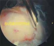 Illustration 30 for Capsular Releases for Loss of Motion: Restore Your Shoulder