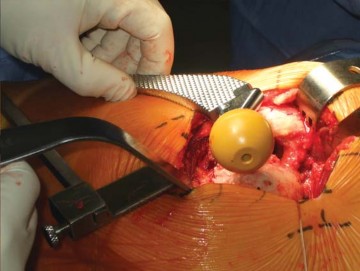 Illustration 76 for Successful Total Hip Replacement in Developmental Dysplasia