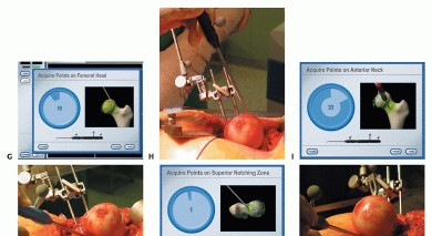 Illustration 28 for Hip Resurfacing: The Bone-Sparing Solution around the Femoral Head