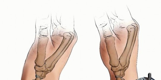 Illustration 26 for Effective K-Wire Fixation: Distal Radius Fractures Without External Fixation