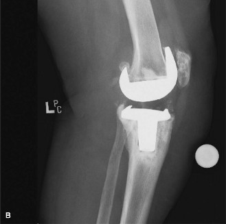 Illustration 2 for Unraveling Your Painful TKR: Diagnosing Infection & Loosening