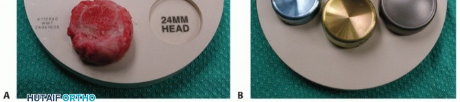 Illustration 16 for Radial Head Arthroplasty: Restoring Elbow Function & Stability