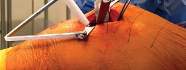 Illustration 28 for Exploring the Ambulatory Surgical Setting for Total Hip Replacement